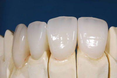  Răng sứ cercon giá bao nhiêu cho răng cửa
