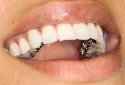 Tìm hiểu chỉnh răng hô móm bằng mắc cài dán mặt trong-2
