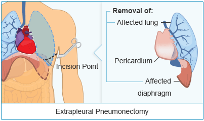 Extrapleural Pneumonectomy (EPP)