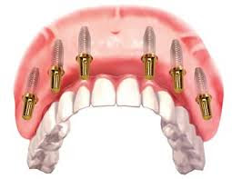 Mất nhiều răng không chỉ ảnh hưởng đến thẩm mỹ mà còn làm cho hàm răng yếu đi