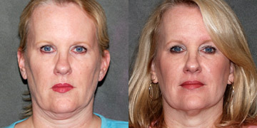 Ultherapy-Before-And-After