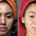 How to Cure and Prevent Teenage Acne ?