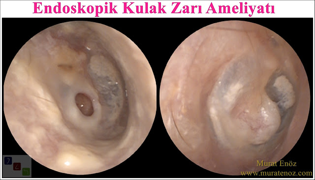 Endoskopik kulak zarı ameliyatı - Endoskopik kulak ameliyatı - Endoskopik kulak zarı tamiri - Endoskopik kulak zarı deliği kapatılması - Endoskopik timpanoplasti - Endoskopik miringoplasti - Endoskopik kulak zarı ameliyatının avantajları - Endoskopik kulak zarı ameliyatının fiyatı - Endoskopik kulak zarı deliği kapatılması - Endoskopik kulak zarı operasyonu