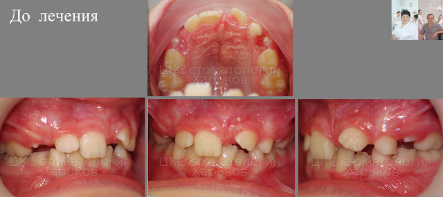  сверхкомплектные зубы, до лечения