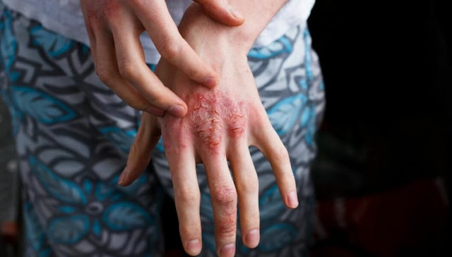 natural treatments for eczema