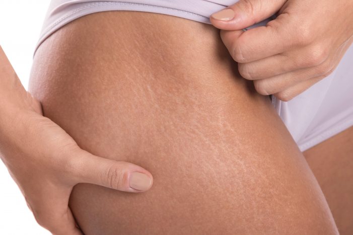 Cara Mudah Hilangkan Stretch Marks Di Paha