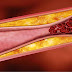 Home remedies to clear blocked arteries