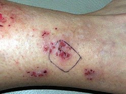 Morgellons Disease Pictures1