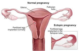 Hamil Di Luar Kandungan (Kehamilan Ektopik)