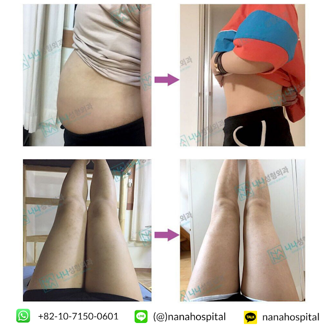 operasi sedot lemak, liposuction, sedot lemak badan, sedot lemak perut, sedot lemak mini, sedot lemak full, badan langsing, badan ideal, olahraga, diet, makanan sehat, operasi plastik korea