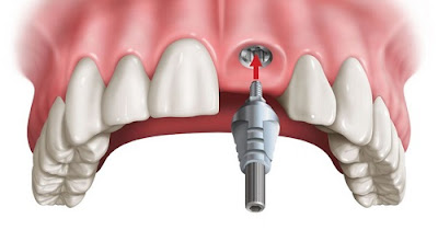 Trồng răng implant có nguy hiểm không? Nha khoa tư vấn 1