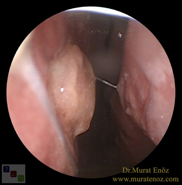 Ekstrakorporeal septum perforasyonu tamiri - Ekstrakorporeal septum perforasyonu ameliyatı - Septum perforasyonu tedavisi - Nazal septum perforasyonu operasyonu - Açık teknik ekstrakorporeal septum perforasyonu ameliyatı - Açık teknik ekstrakorporeal septum perforasyonu onarımı - Burun estetiği ile birlikte ekstrakorporeal septum perforasyonu kapatılması - Ekstrakorporeal burun septumunda delik kapatılması - Burunda delik oluşumu - Burun duvarında delik - Burun kıkırdak delinmesi tedavisi - Septum perforasyonu ameliyatı olanlar - Septum perforasyonu olanlar - Septal perforasyon tamiri - Ekstrakorporeal burun septum perforasyonu ameliyatı - Extracorporeal septum perforation closure in Istanbul - Extracorporeal septum perforation closure in Turkey - Extracorporeal closure of nasal septal perforations subcutaneous tissue - Combining rhinoplasty with extracorporeal septal perforation repair