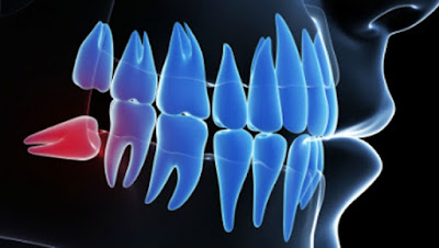 Có nên nhổ răng khôn hàm dưới giảm đau không?