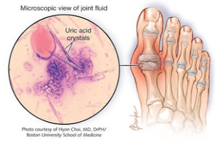 Penyakit Gout: Penyebab, Gejala, Diagnosis, Pengobatan