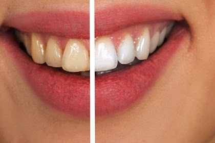 Dental Veneers in Turkey and Dentist Costs