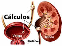 calculos al riñon