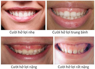 Cười hở lợi phải làm sao-1