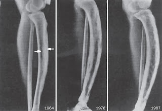 Deformación de tibia en persona con EP