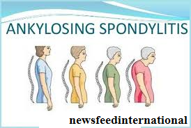 spondylitis treatment exercises