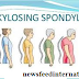 Ankylosing Spondylitis Symptoms and Treatments