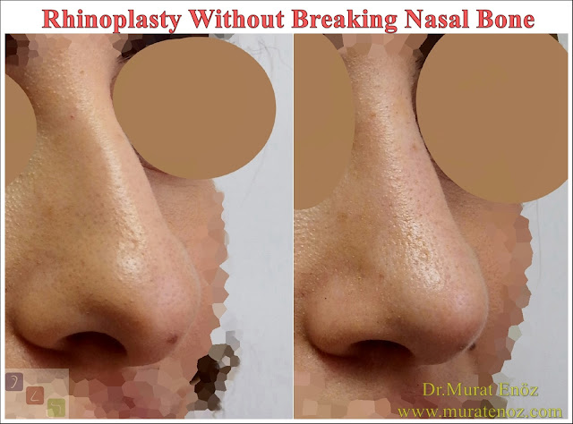 Rhinoplasty Without Breaking Nasal Bone - Rhinoplasty Without Breaking Nasal Bone - Female Nose Aesthetic Surgery - Nose Jobs For Women - Nose Reshaping for Women - Best Rhinoplasty For Women Istanbul - Female Rhinoplasty Istanbul - Nose Job Surgery for Women - Women's Rhinoplasty - Nose Aesthetic Surgery For Women - Female Rhinoplasty Surgery in Istanbul - Female Rhinoplasty Surgery in Turkey