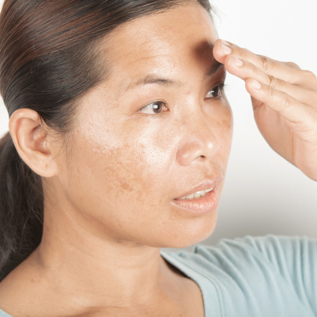 WHAT CAUSES MELASMA? Treatments, Types, Prevention pynocare morena filipina skin care blog