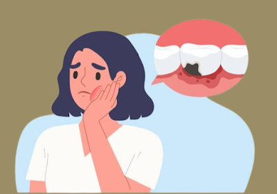 the stages of cavity progression and its impact on oral health.