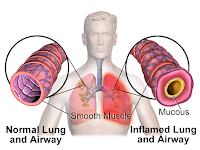 bronchite asthmatiforme affectation
