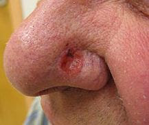 nose skin cancer