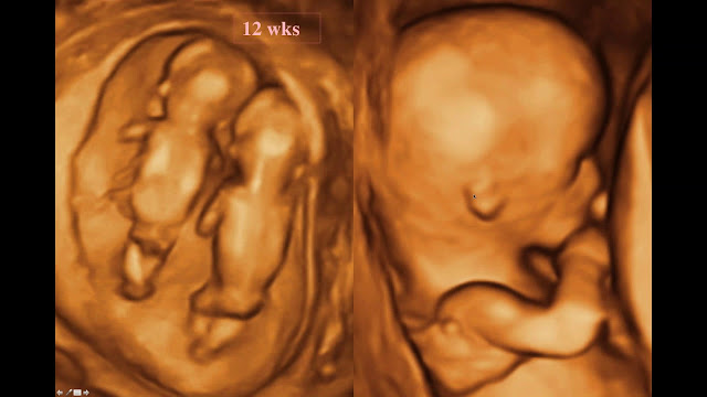 Fetal Anomaly Scan