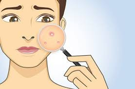 Ways To Get Rid Of Acne ,typesof acne,bacteria causes acne 
