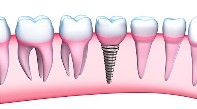 Cấy ghép răng Implant giá bao nhiêu tiền?