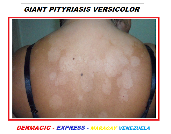 Pitiriasis versicolor gigante