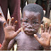 Monkeypox: FCT Records Seven Suspected Cases