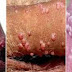 Cari Obat kutil kelamin kapsul Salep dan madu Asli di Apotik thumbnail
