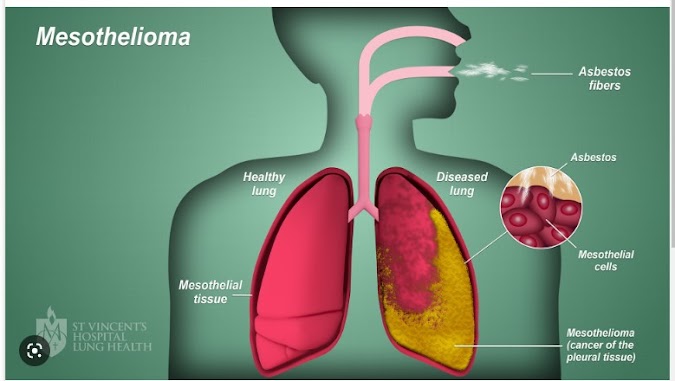 All About Mesothelioma