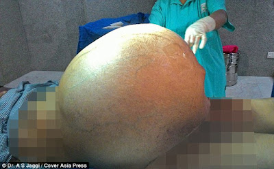  Giant Ovarian Tumor Removed From Woman's Abdomen After 5 Years Of Suffering (Viewers Discretion)