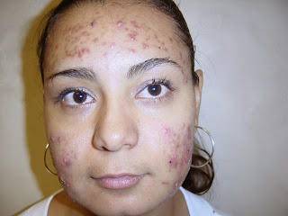 Como Eliminar El Acne