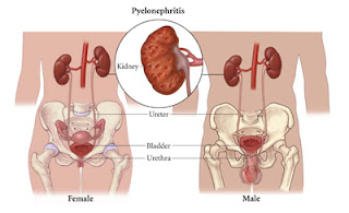 pielonefritis