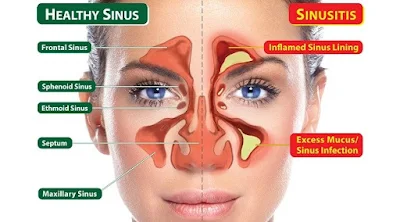 Penyebab dan Gejala Flu dan Sinusitis