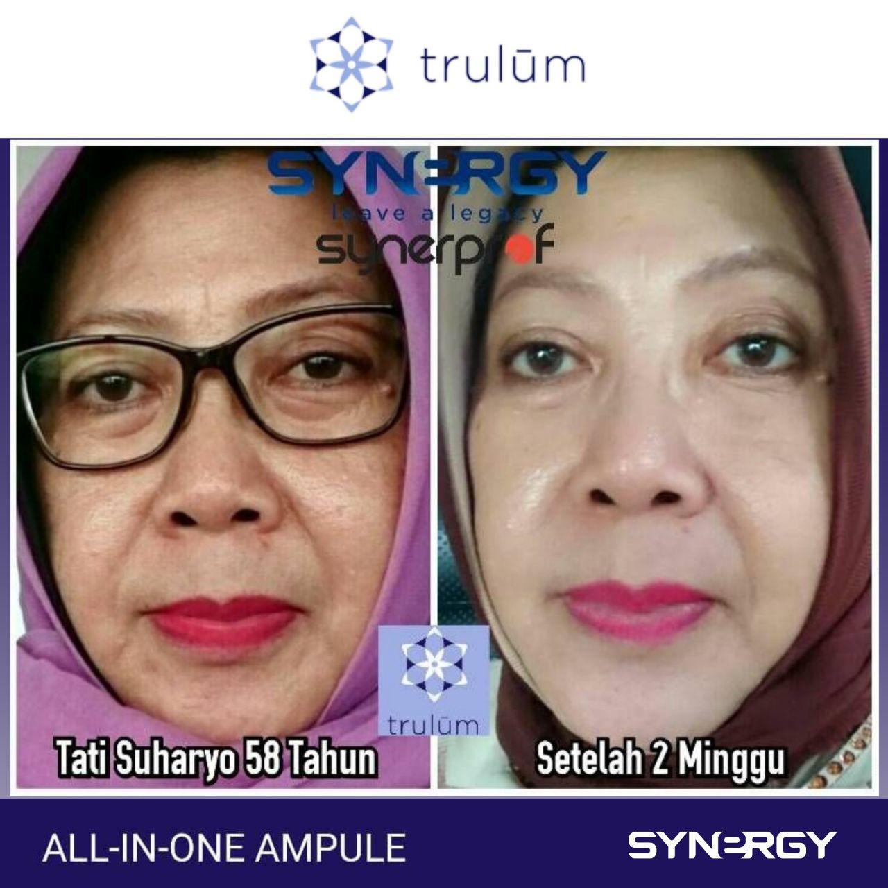 Trulum Skincare Synergy Obat Flek Hitam Di Hidung Di Area Bojongkalong, Nyalindung, Sukabumi Hubungi 6281-1233-8376