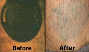 Why Choose Natural Tattoo Removal Instead of The Others?