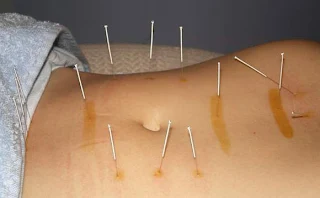 How put needles on the body? How does acupuncture work? Do the points used are specific points located?