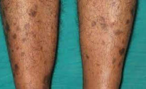 Dark spot remover on body ,legs and tishwebebe