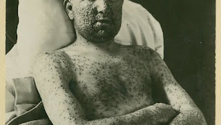 Skin of patient of Smallpox