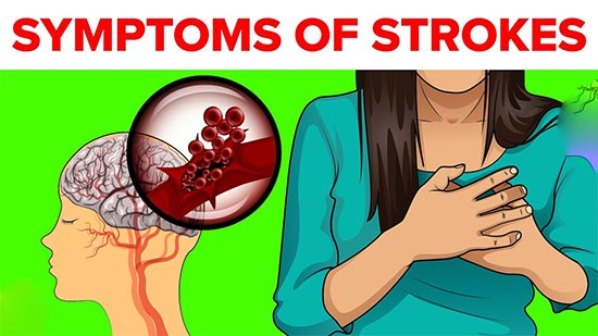 Symptoms Of Strokes In Women