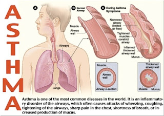 causes and symptoms for asthma disease