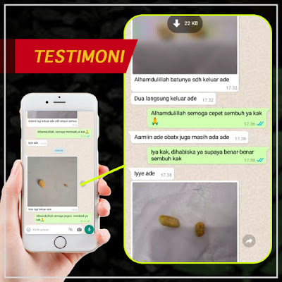 Obat Batu Ginjal Mosehat