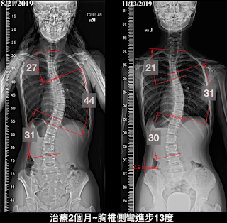 脊椎側彎度數改善、脊椎側彎矯正成功、大腦學習訓練法、脊椎側彎運動、脊椎側彎矯正