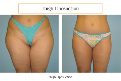 thigh liposuction surgery to lose weight